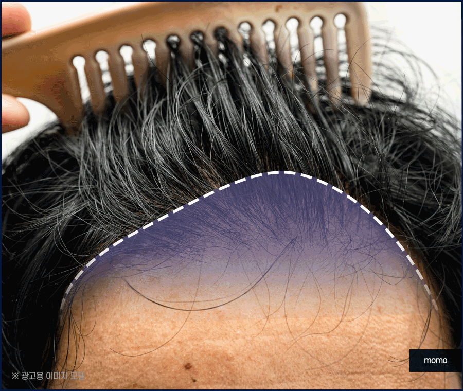 모발이식 3000모 비용 차이나는 이유 및 방법 관련 이미지 7