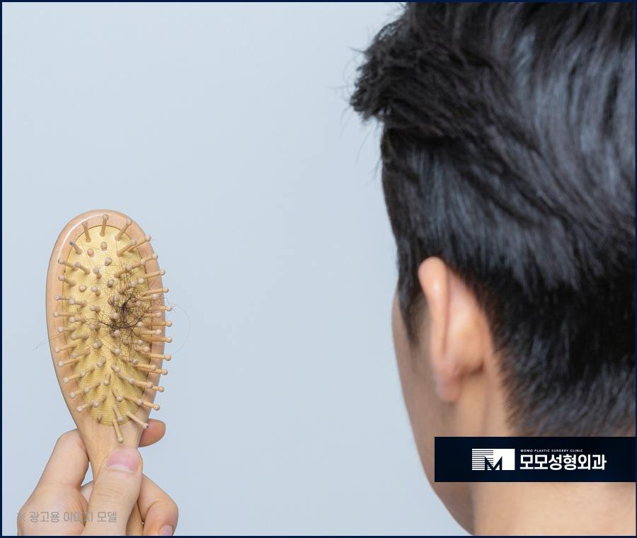 안드로겐성탈모 원인과 개선을 위한 방안은 관련 이미지 2