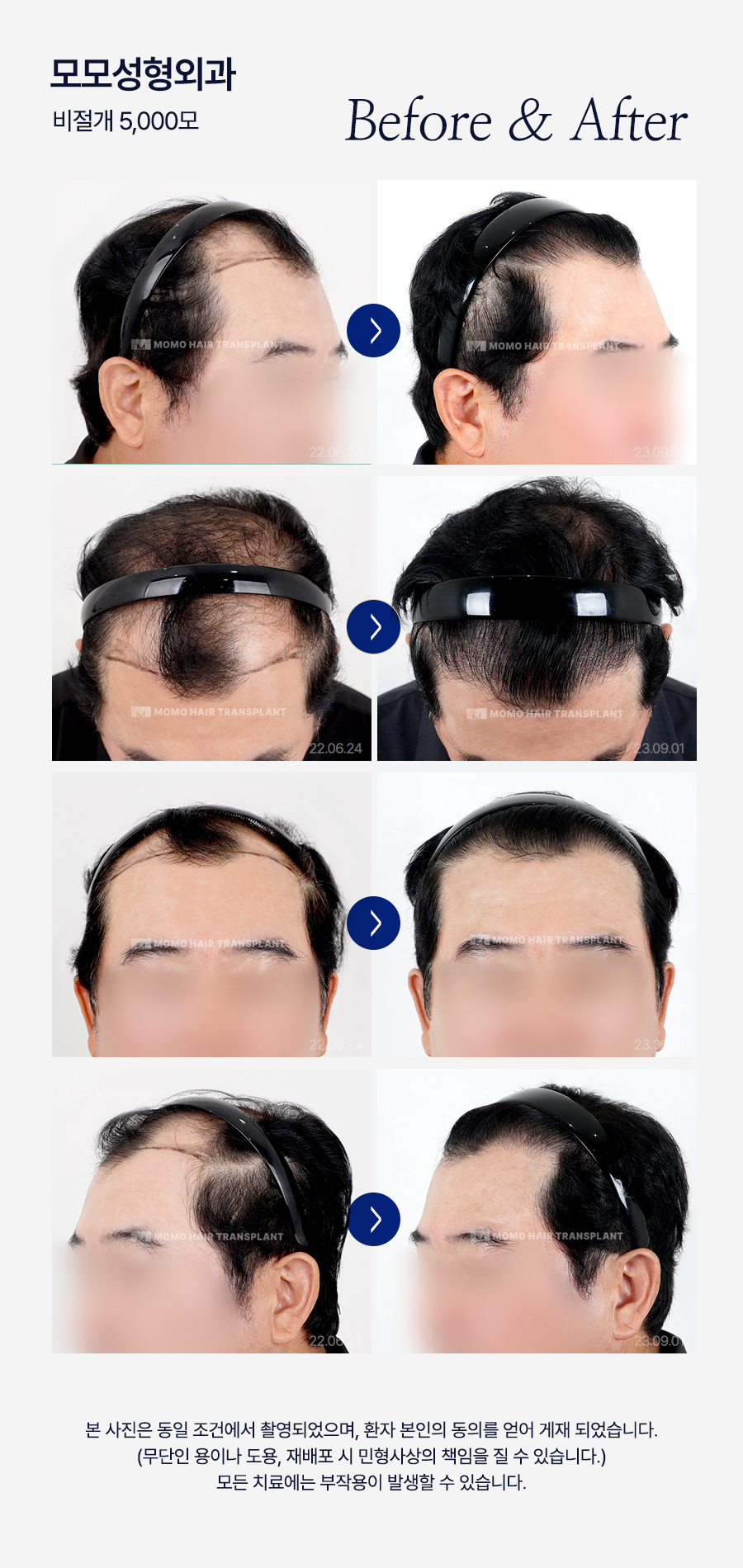 M자탈모치료 모발이식이 특별한 이유 3가지 관련 이미지 16