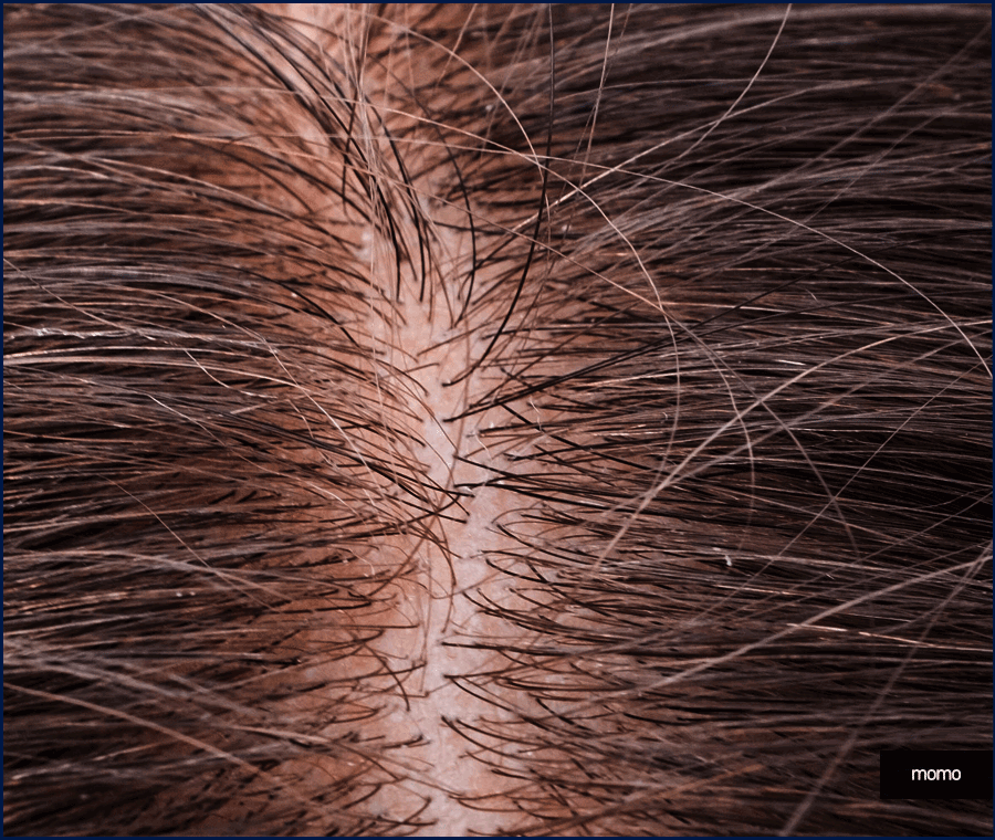 여자 가르마 탈모 모발이식으로 효과보려면? 관련 이미지 9