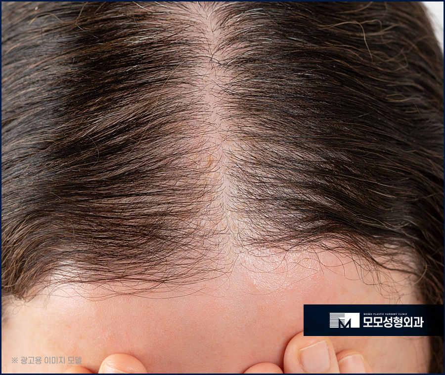 여성헤어라인모발이식 채워 주기 위한 방법은 관련 이미지 2