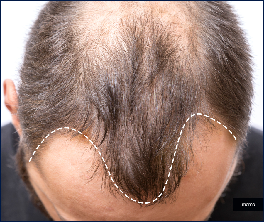 M자모발이식비용 가격 탈모 탈출을 위한 관련 이미지 6