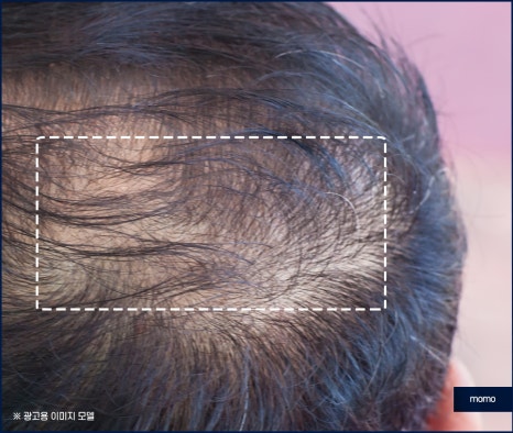 압구정 모발이식 탈모 문제를 해소하는 관련 이미지 9