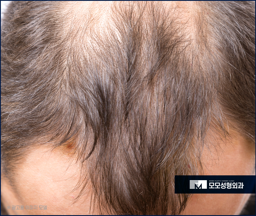 m자탈모모발이식비용 어느 정도가 적절할까요 관련 이미지 3