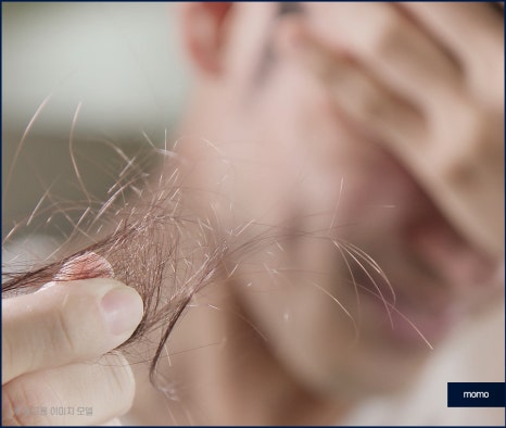 m자탈모초기 빠른 대처를 이뤄낸다면 관련 이미지 4