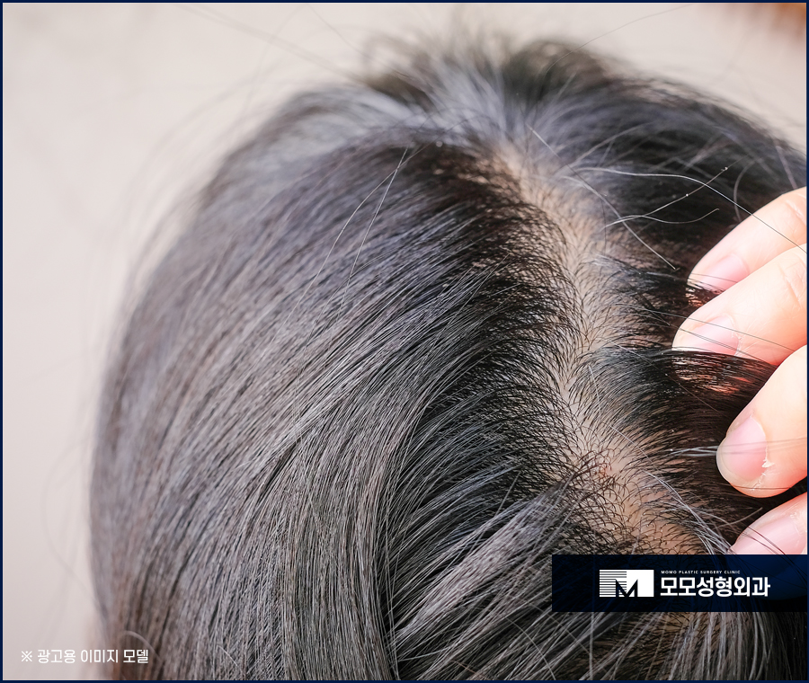 신사 탈모치료 나에게 필요한 맞춤 방안 관련 이미지 7