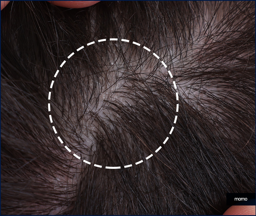 비절개 모발이식 비용 무삭발로 회복까지 빠르게 관련 이미지 2