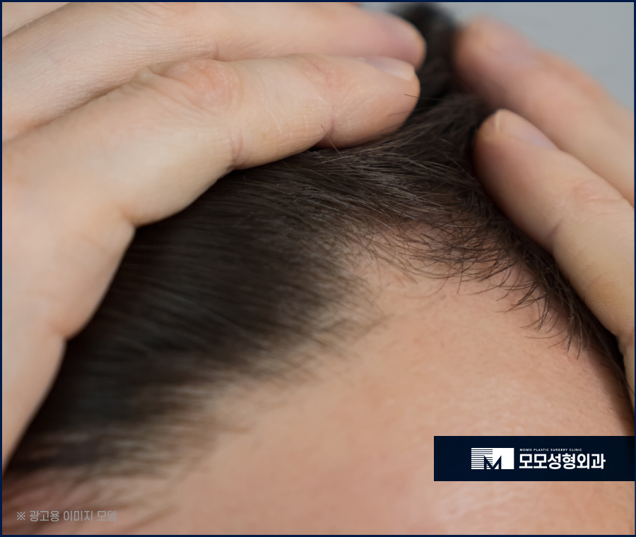 여성헤어라인모발이식 채워 주기 위한 방법은 관련 이미지 6