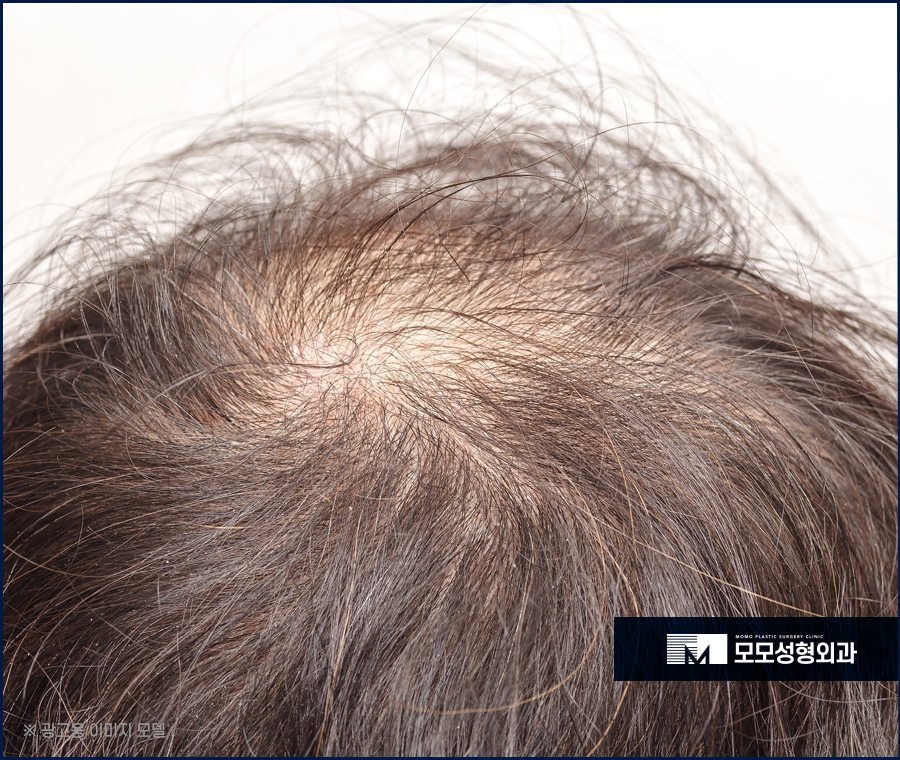 남자정수리탈모 원인부터 체크하고 관련 이미지 5