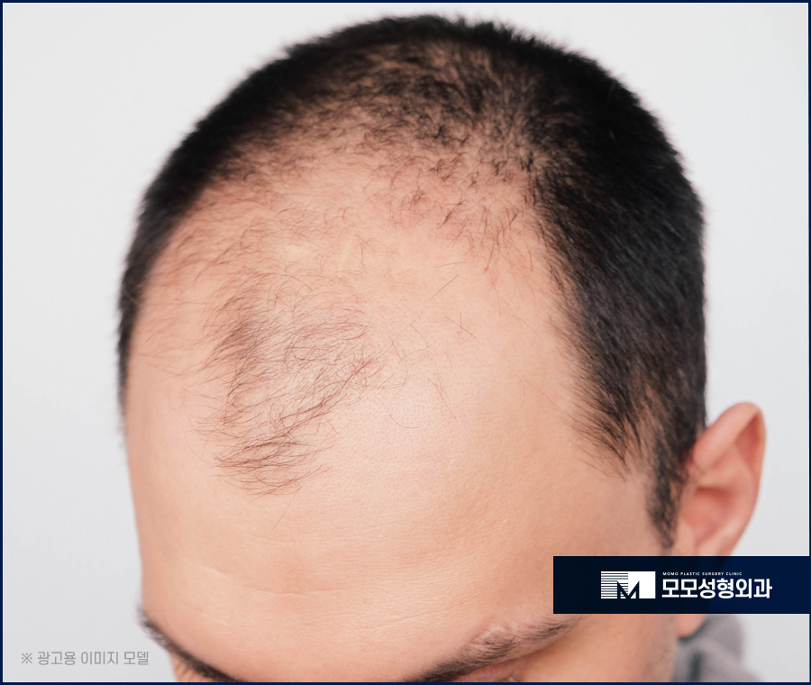 넓은이마모발이식 방향과 밀도까지 고려해 관련 이미지 3