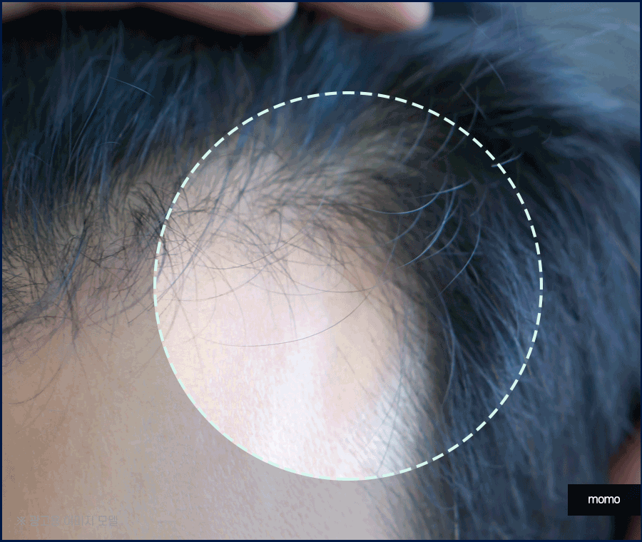 모발이식 3000모 비용 차이나는 이유 및 방법 관련 이미지 9