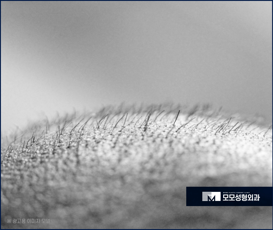 비절개모발이식가격 꼼꼼히 살펴보며 함께 체크할 점 관련 이미지 8