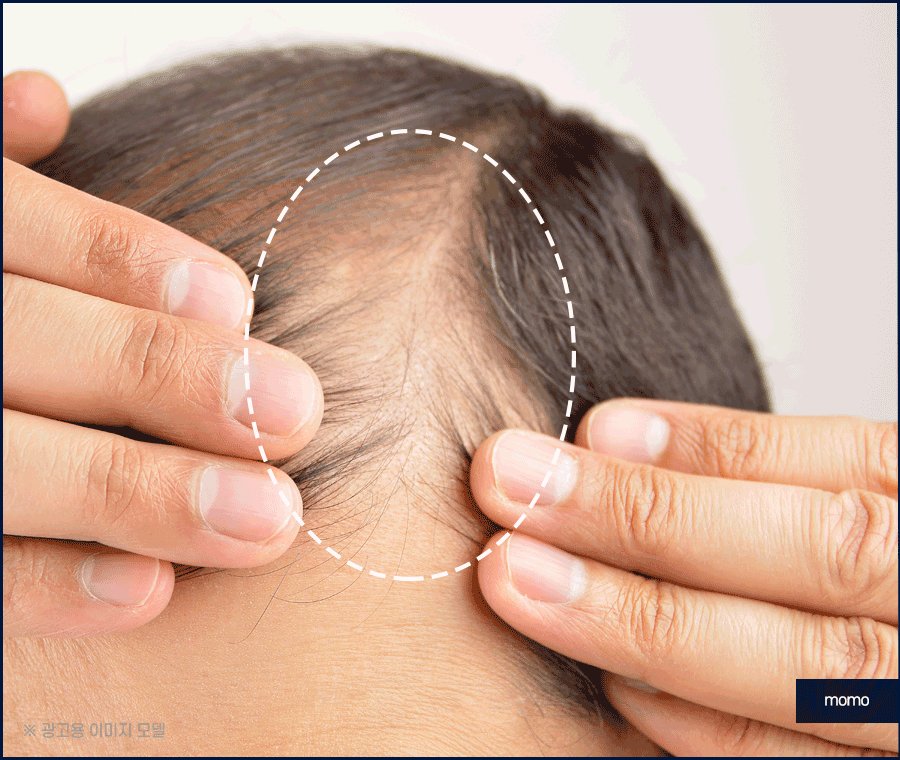 머리심기 비용 및 시술별 장단점 알아보기 관련 이미지 6