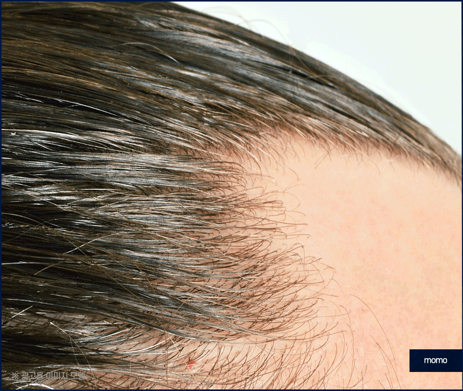 m자탈모병원 모발이식 고민이신 분들이라면 필독 관련 이미지 8