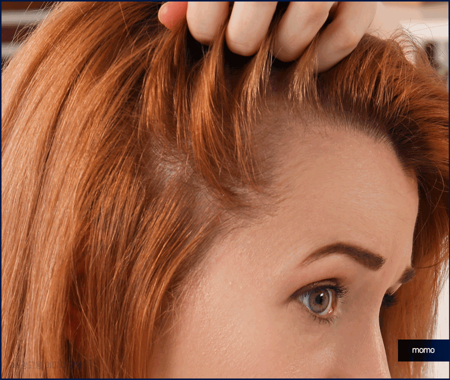 여자 측두부 탈모 아름다운 옆모습을 만드는 방법 관련 이미지 5