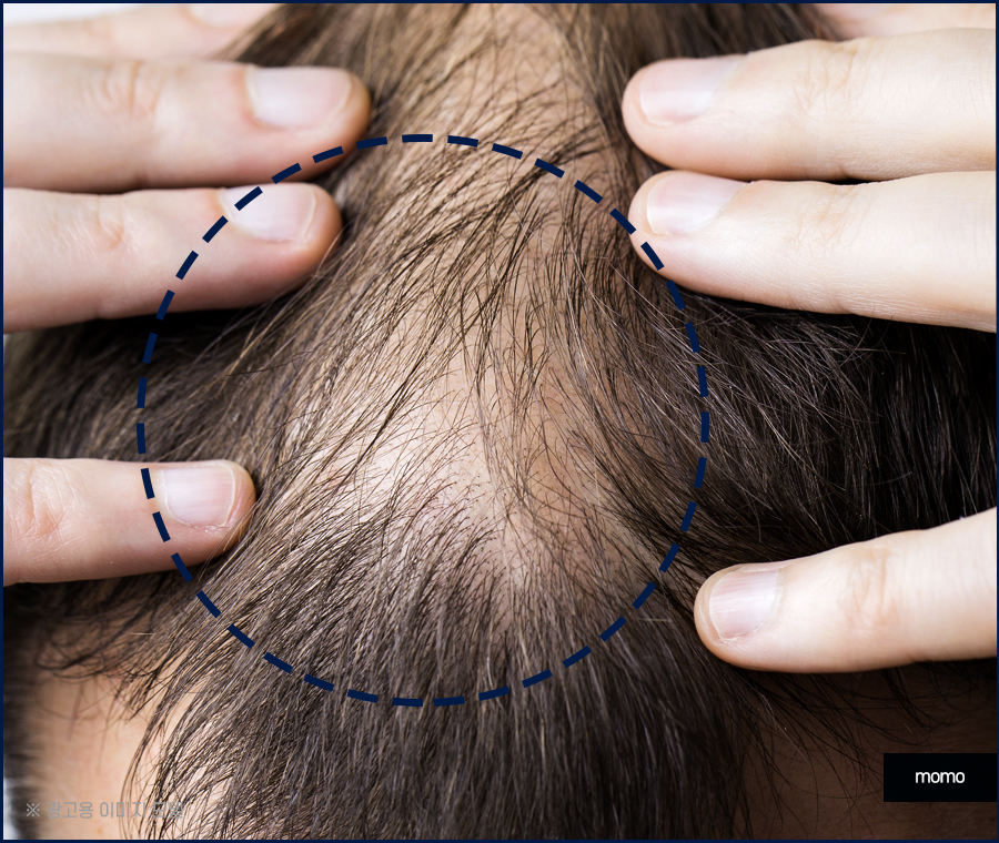 머리카락 얇아짐 발생하는 이유부터 회복 방안 관련 이미지 8