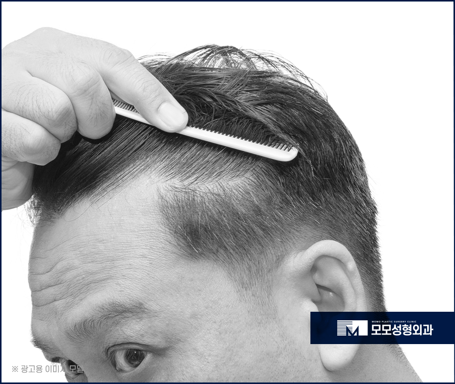 비절개모발이식가격 꼼꼼히 살펴보며 함께 체크할 점 관련 이미지 4