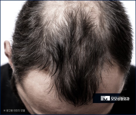 남자헤어라인모발이식 디자인까지 꼼꼼하게 고려하며 관련 이미지 6