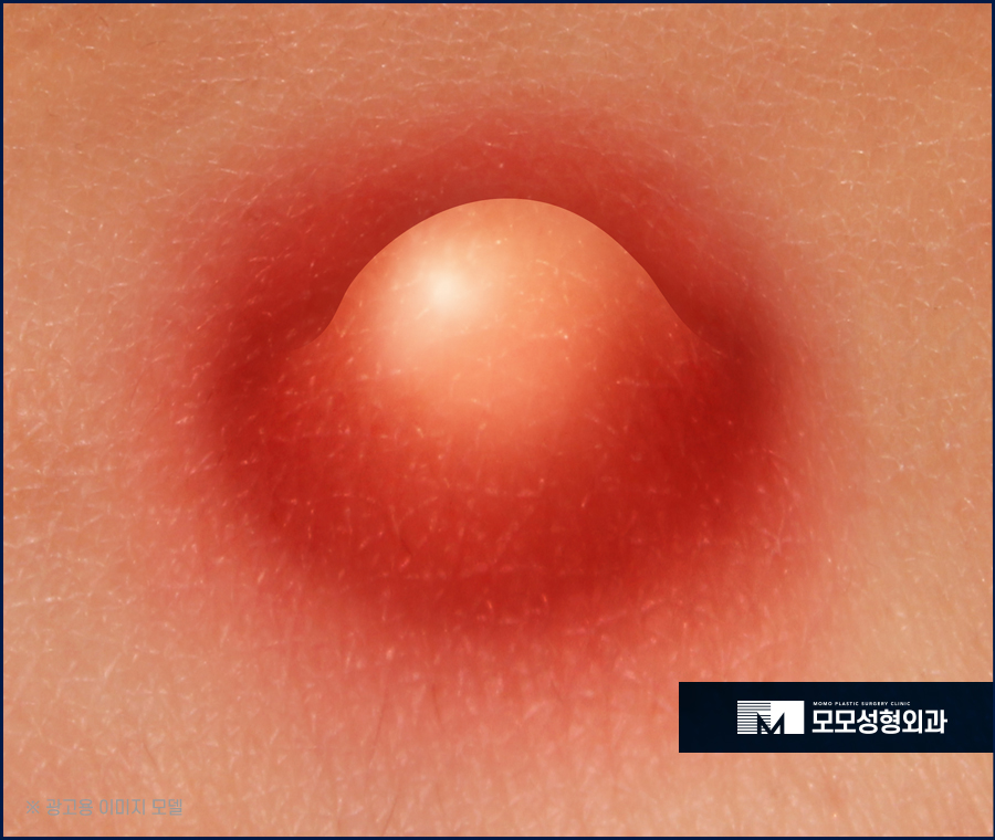 두피뾰루지원인 부터 조치하는 방법은 관련 이미지 4