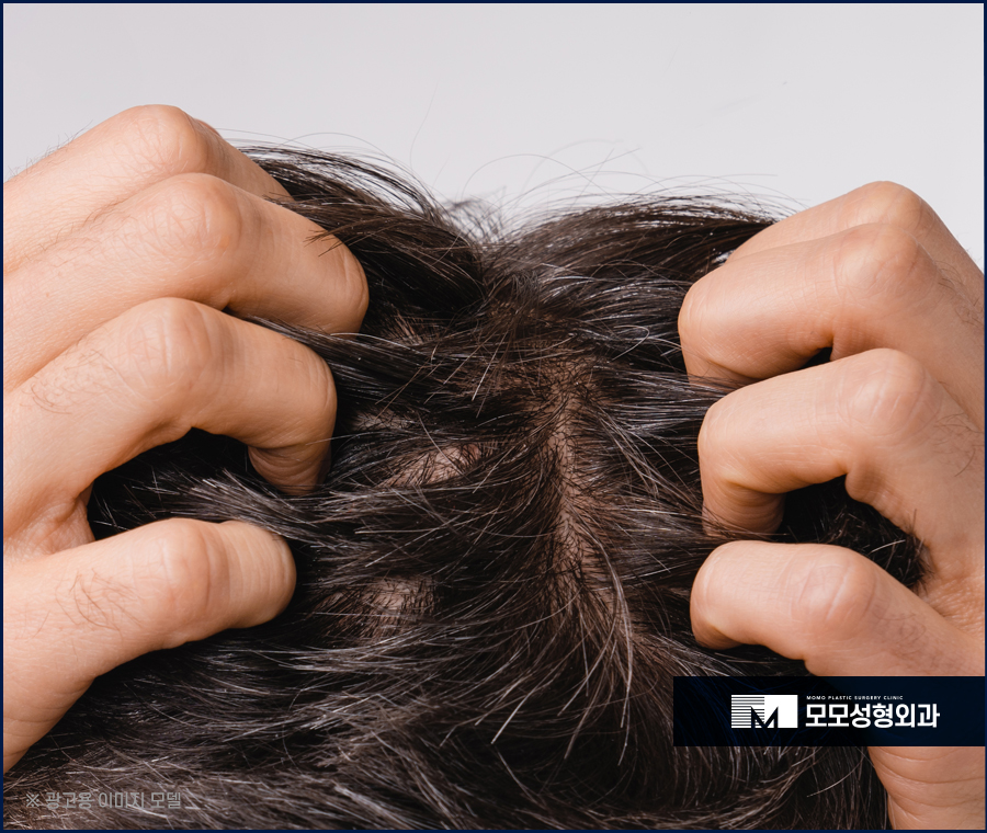 모발이식 암흑기를 이겨내기 위해 알아야 할 점 관련 이미지 2