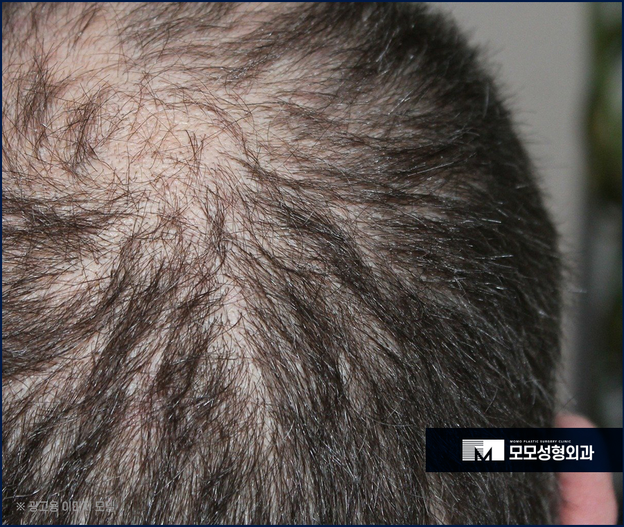 신사역 모발이식 디자인이 중요시 여겨지는 이유 관련 이미지 7