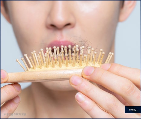 모발이식병원추천 선택 시 꼭 체크할 사항 3가지 관련 이미지 3