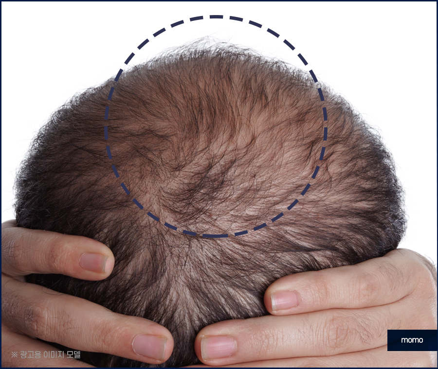 비절개 모발이식 비용 무삭발로 회복까지 빠르게 관련 이미지 6