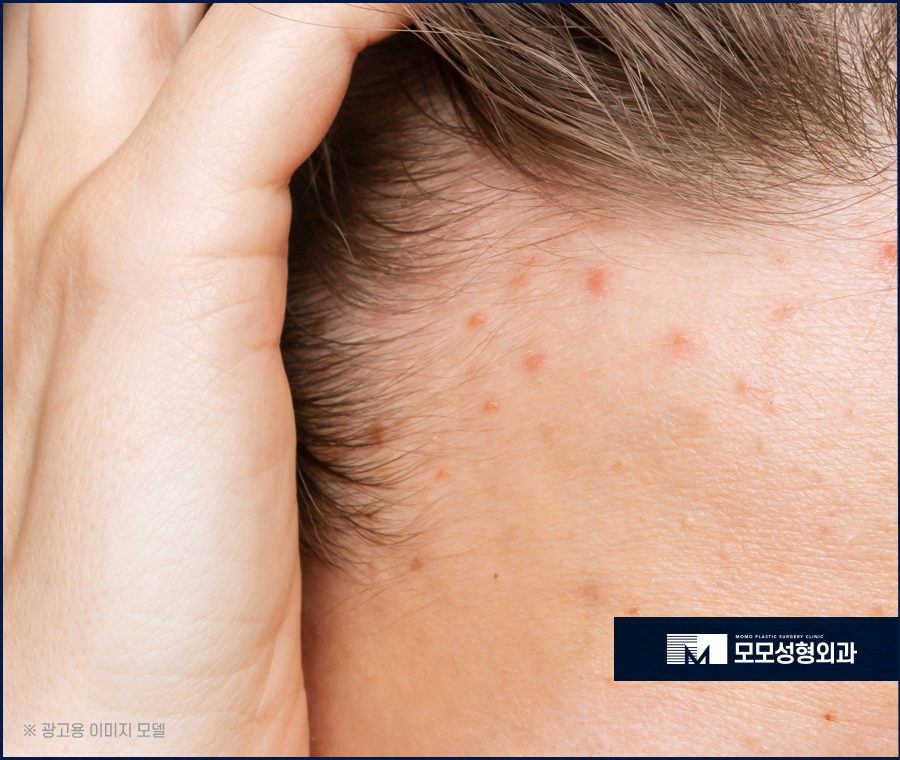 여성 헤어라인 모발이식 미모까지 완벽해 지는 효과 관련 이미지 3