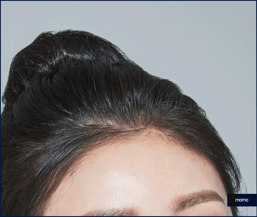 서울 탈모 성지 풍성함을 만들기 위한 방법 2가지 관련 이미지 6