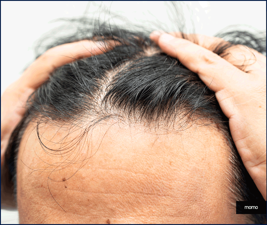 M자탈모치료 모발이식이 특별한 이유 3가지 관련 이미지 6