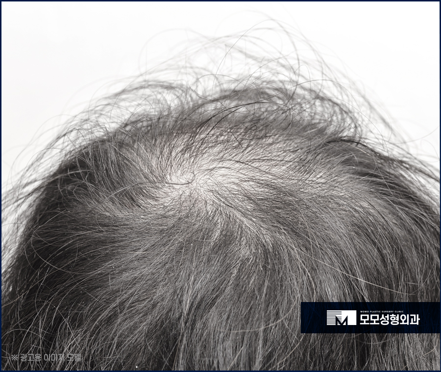 정수리탈모병원 분석부터 꼼꼼하게 하는 곳에서 관련 이미지 2