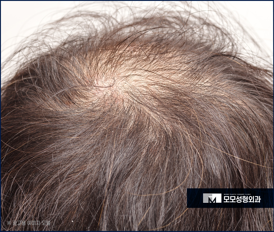 모발이식생착률 높여가는 과정을 통해 관련 이미지 2