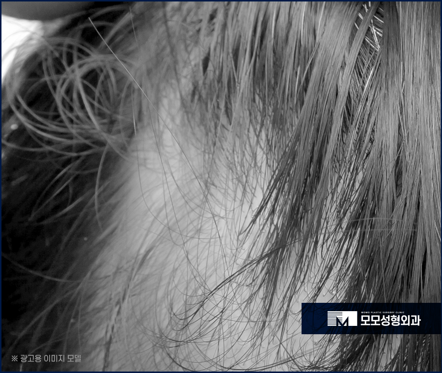 압구정 모발이식 안정적인 생착을 만드는 관련 이미지 11