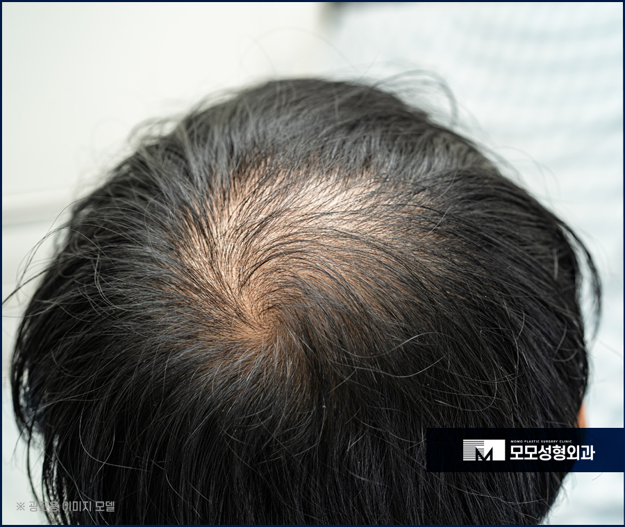 비절개모발이식가격 나에게 꼭 맞는 방향을 설정해서 관련 이미지 2