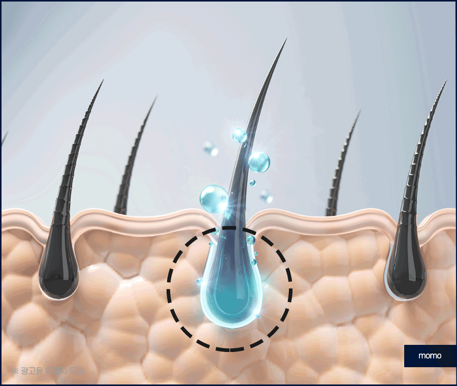 모발이식 3000모 비용 차이나는 이유 및 방법 관련 이미지 3