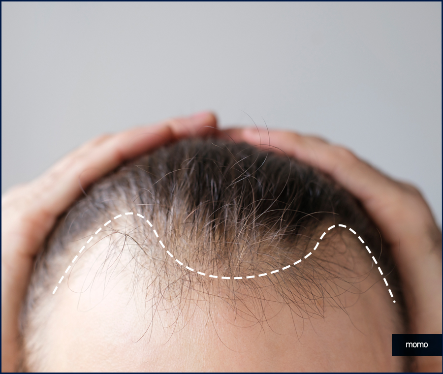 강남 모발이식 정교하게 보완하는 관련 이미지 8