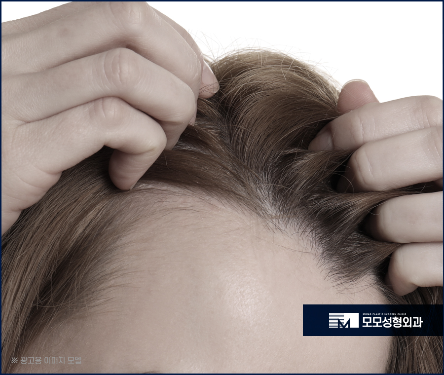여자헤어라인모발이식 이마 높이 변화로 작은 얼굴 효과 관련 이미지 2