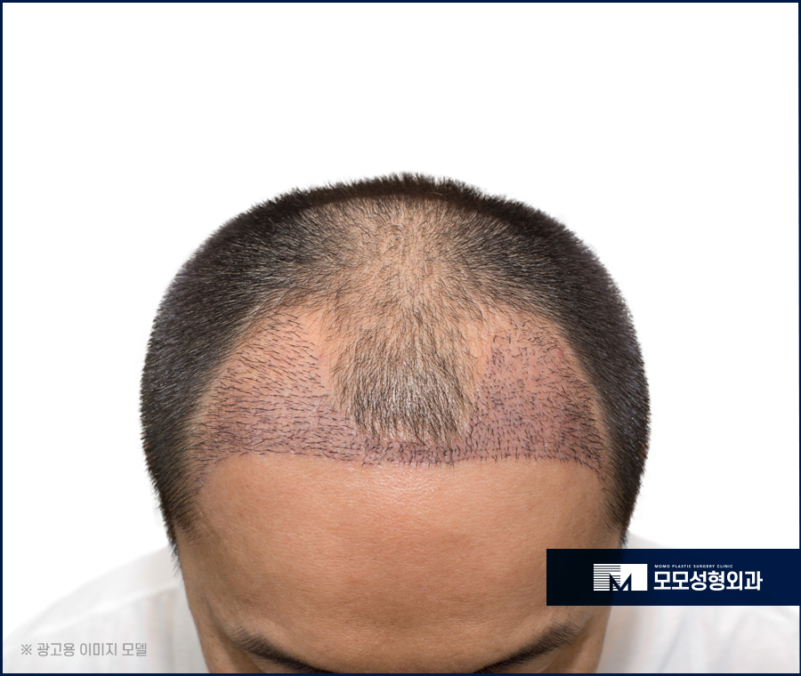 m자탈모초기증상 면밀하게 관찰해야 하는 이유 관련 이미지 8