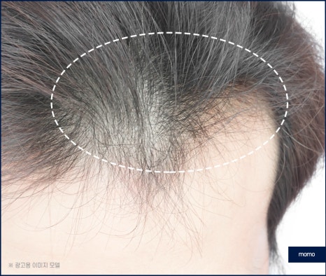 압구정역 모발이식 방법 및 생착률을 높이는 팁 관련 이미지 5
