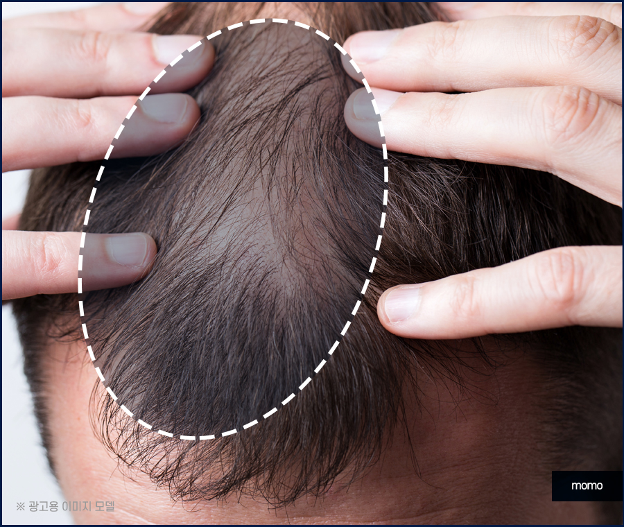 남자 가르마 탈모 진짜 내 머리처럼 채우려면 관련 이미지 5