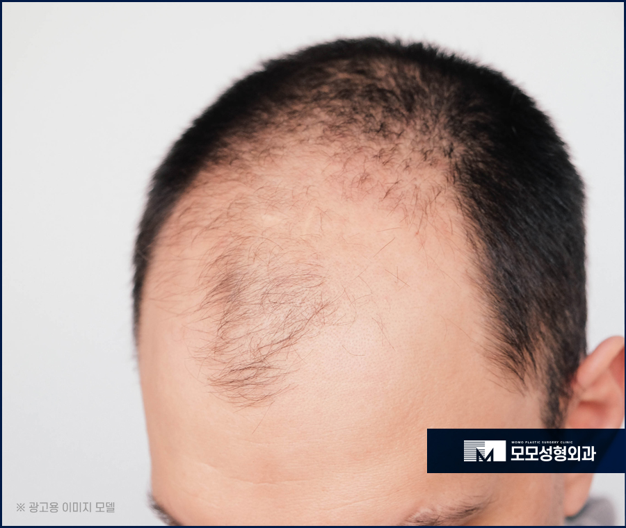 대량모모발이식 풍성함을 이뤄내는 관련 이미지 3