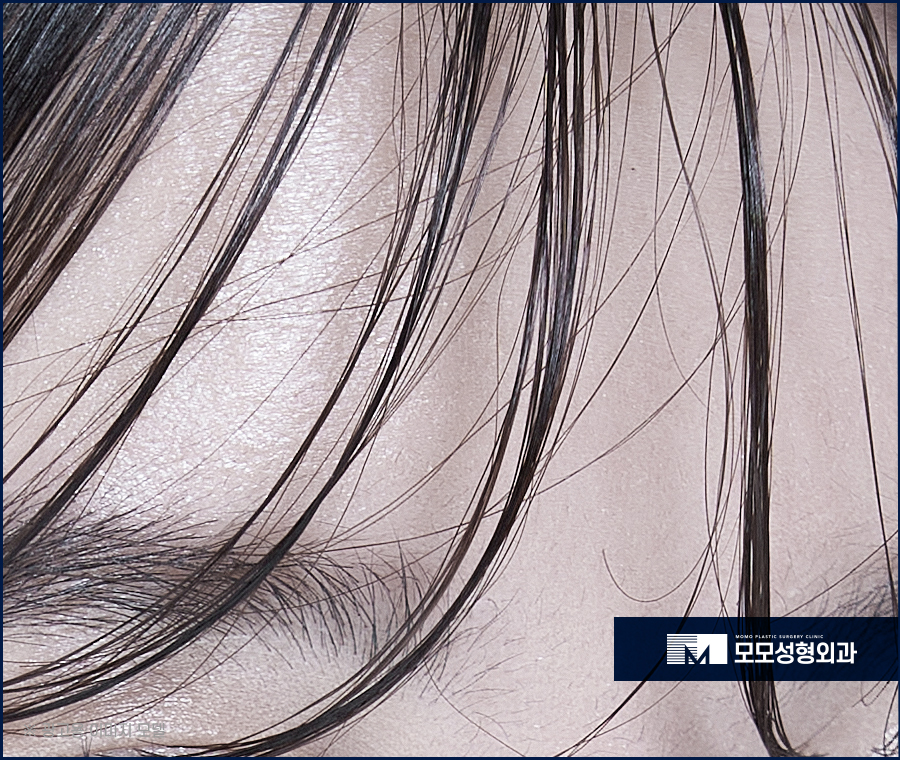 앞머리갈라짐 탈모 해결 방법까지 알아 보는 관련 이미지 5