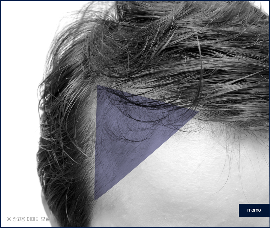 청소년 m자 탈모 요인 분석이 중요한 이유 관련 이미지 2