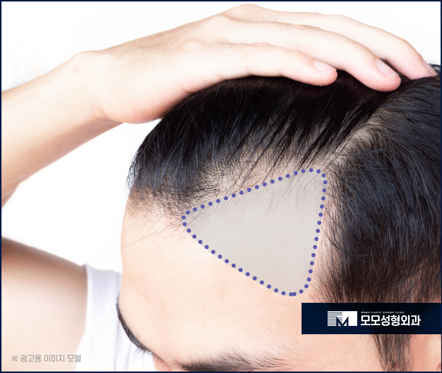 M자모발이식가격 참고해야 할 사항은 관련 이미지 2