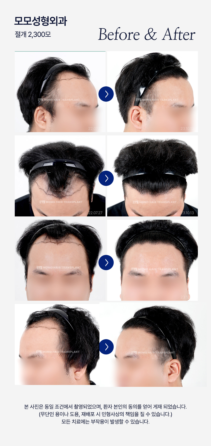 모발이식 생착기간 섬세한 관리가 필요한 이유 관련 이미지 15