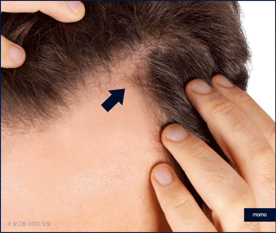 모발이식 생착률 높이기 위한 솔루션은 관련 이미지 3