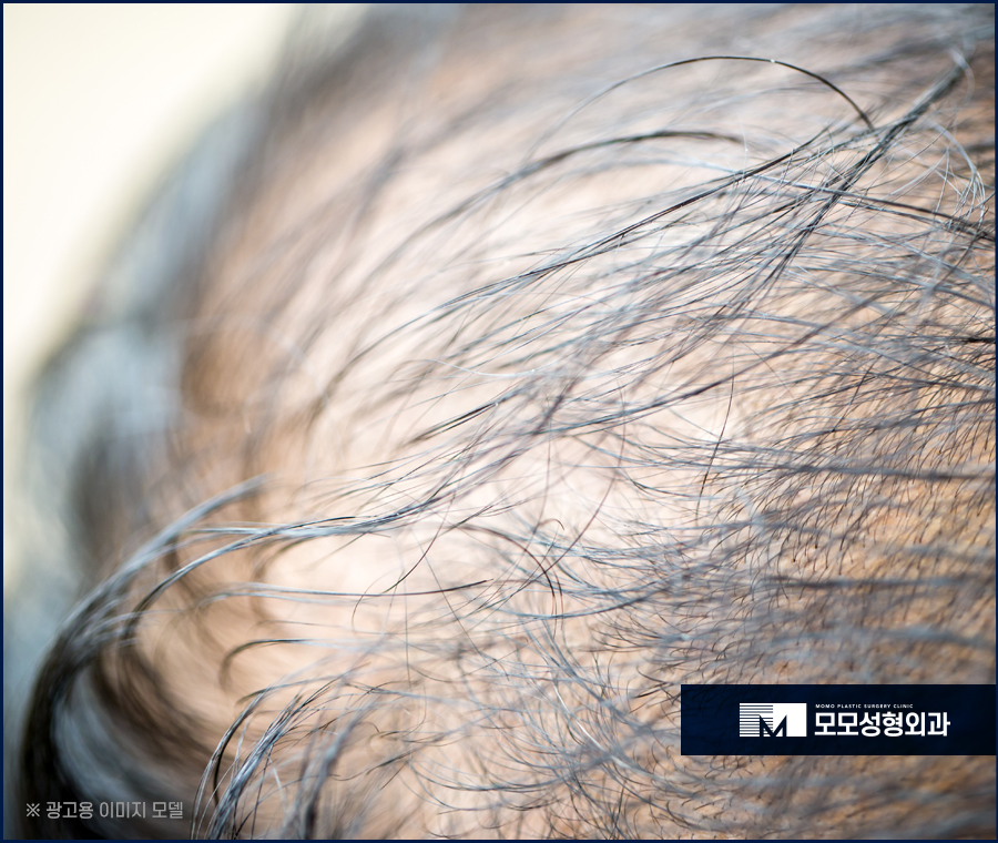 절개모발이식통증 대략적인 수준은 관련 이미지 2