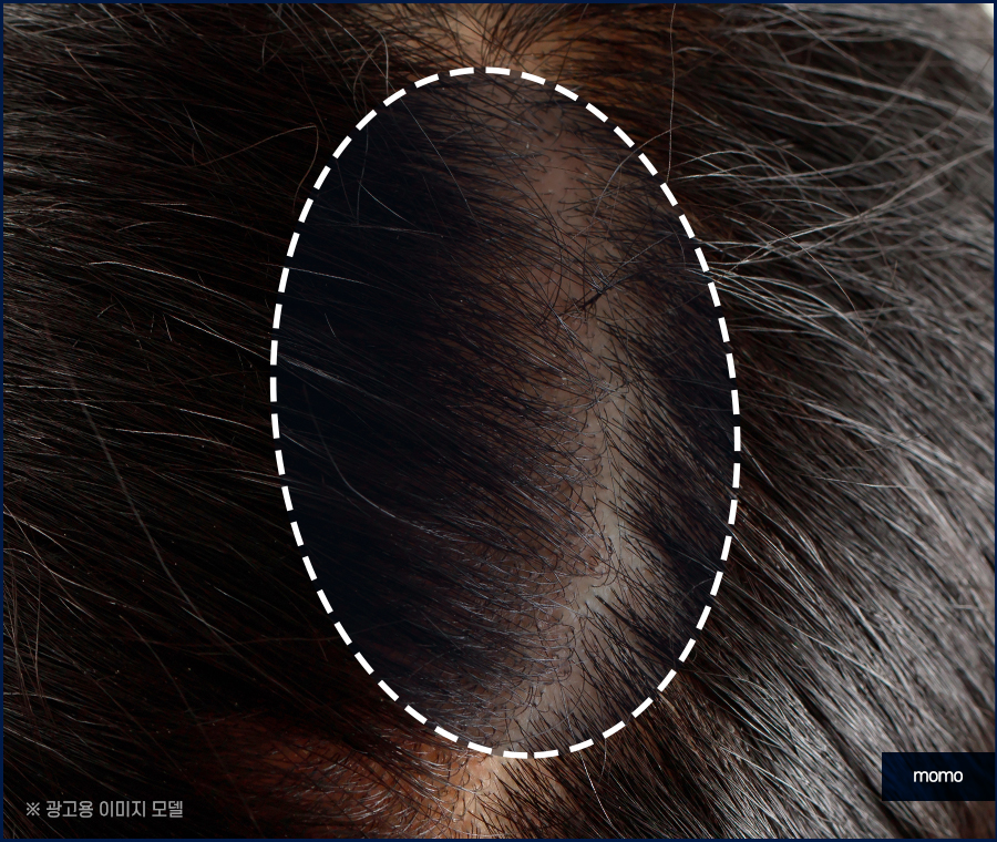 남자 가르마 탈모 진짜 내 머리처럼 채우려면 관련 이미지 2