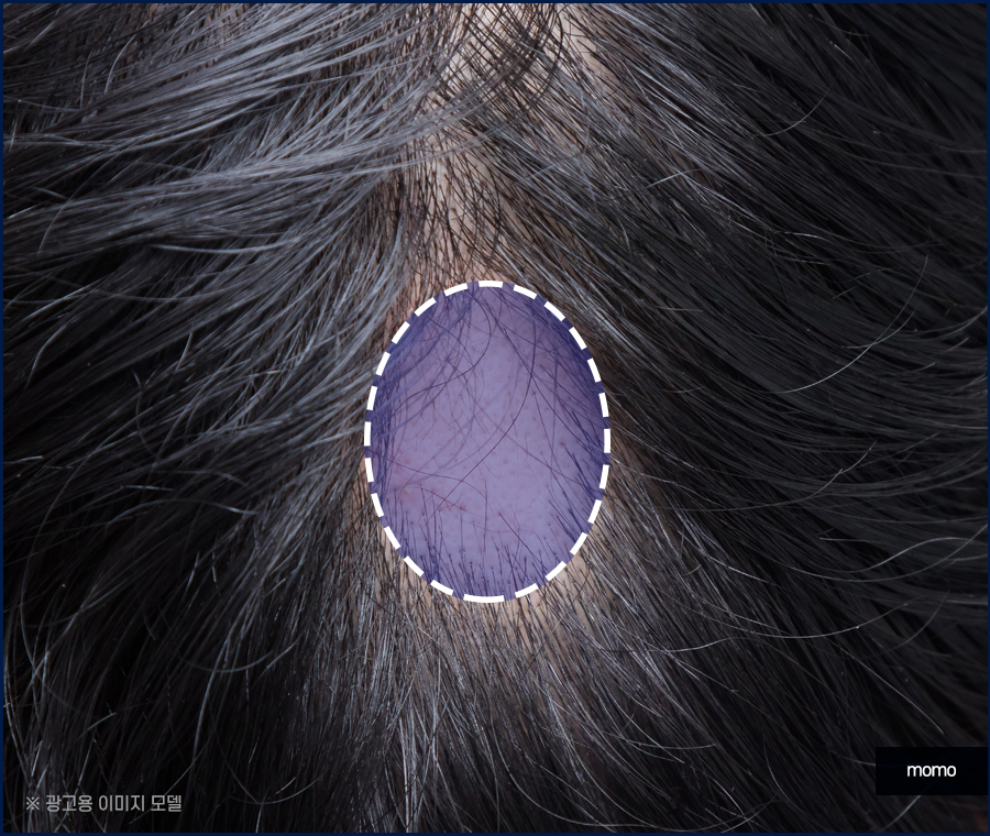 스트레스성 원형탈모를 유발하는 원인은 관련 이미지 3