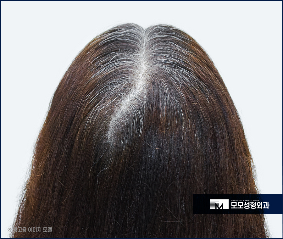 여성 정수리 모발이식 섬세한 집도가 중요한 이유 관련 이미지 5